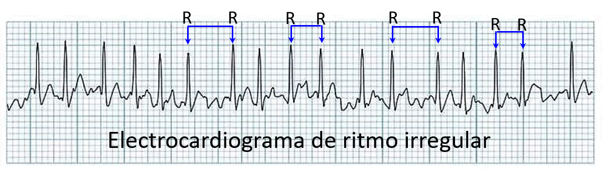 EKG ritmo irregular EKG ritmo irregular